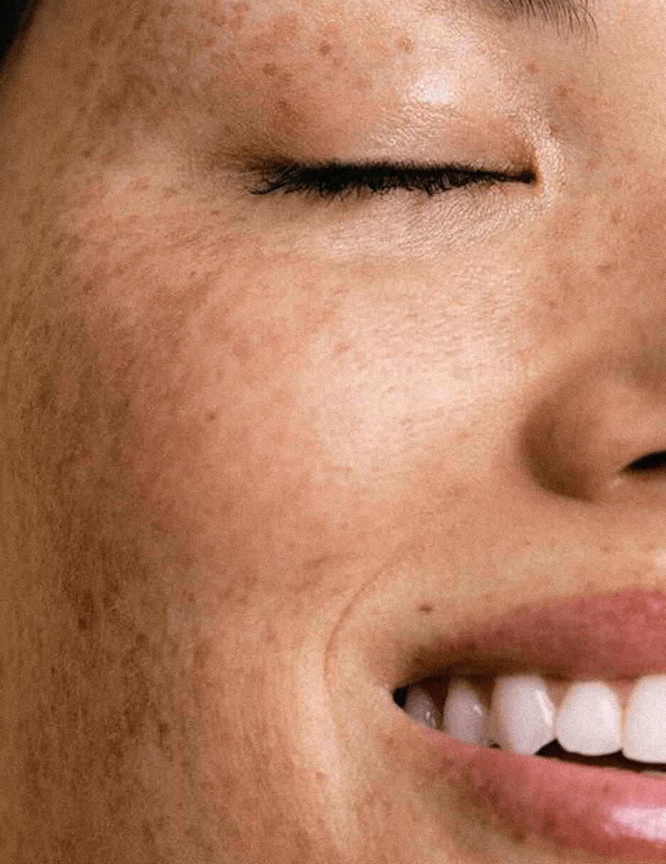 rostro con hiperpigmentación